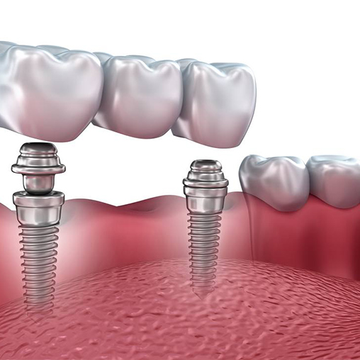 implantes dentales